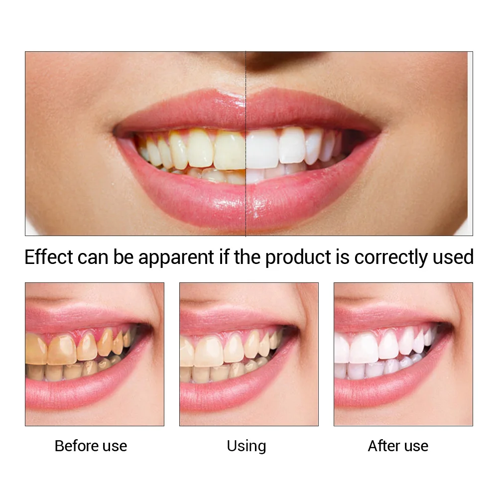 FTEENPLY diş beyazlatma özü to - Teeth Whitening Near Me incelemesi ve fiyatı