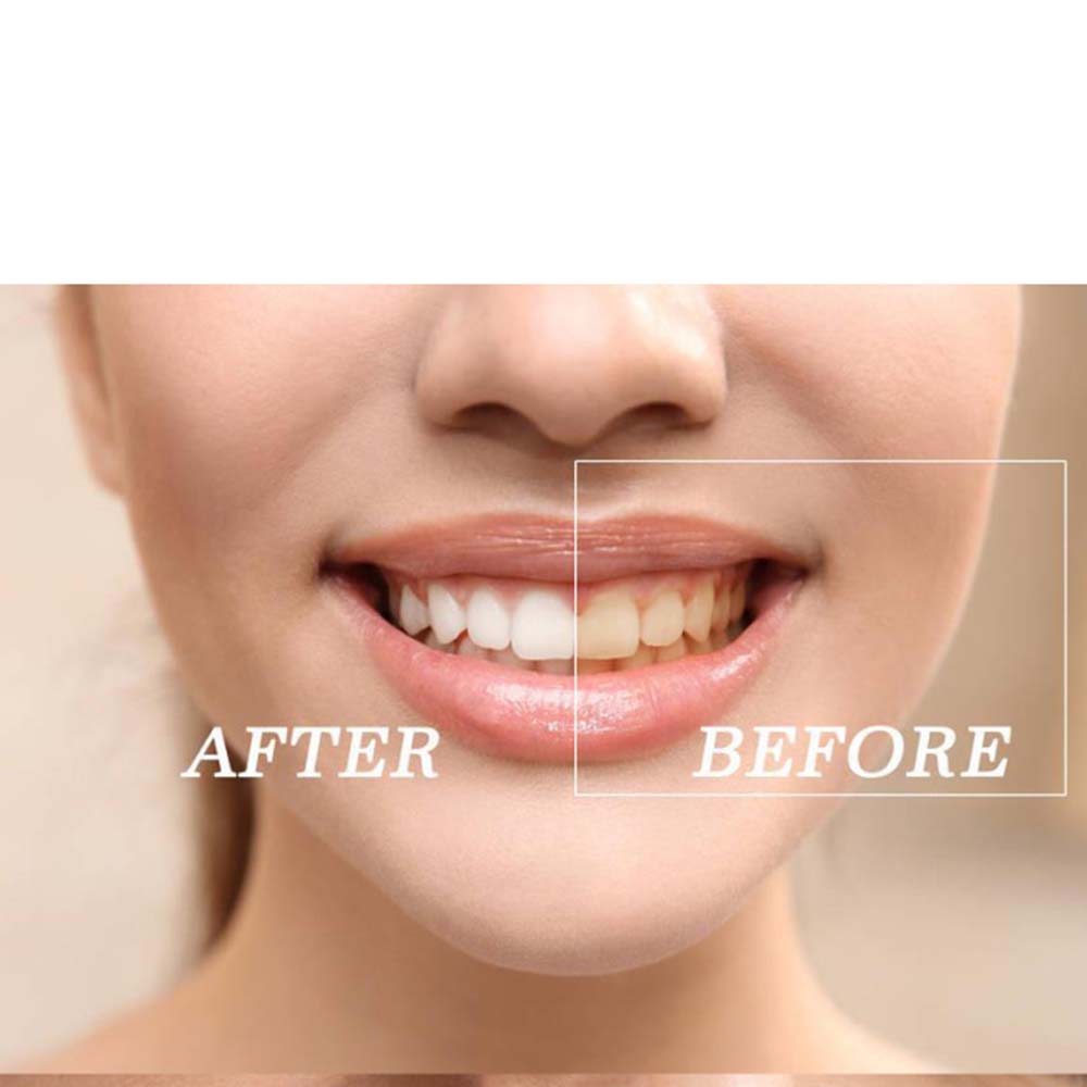En kaliteli peroksit diş beyaz - Teeth Whitening Kit incelemesi ve fiyatı