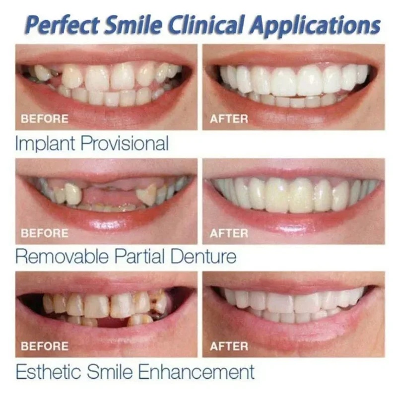 Çıkarılabilir Kaplama Diş Seti - Teeth Whitening Kit incelemesi ve fiyatı